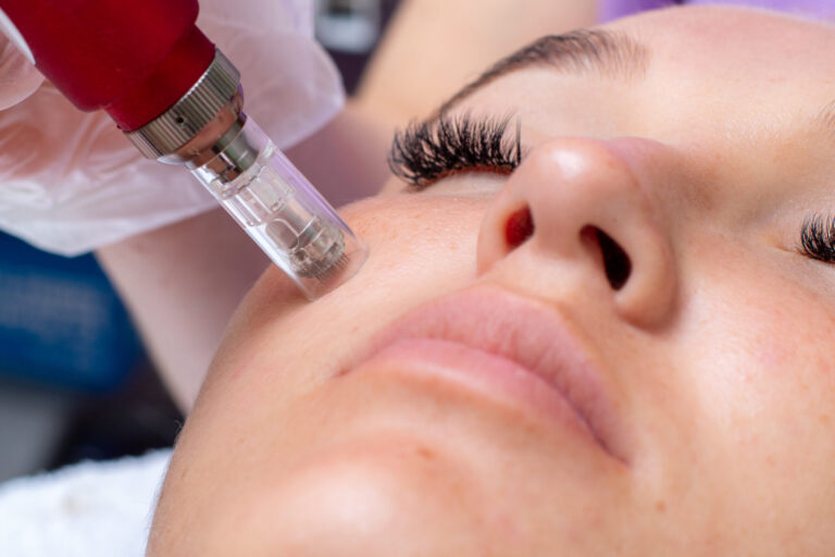 Achieving Flawless Skin with Microneedling