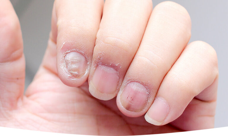 Understanding Fungal Nail Infections: Causes, Symptoms, and Treatments