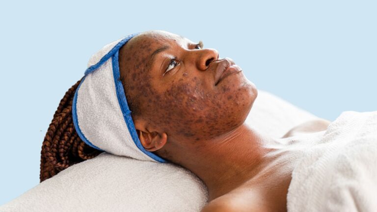 Understanding Acne: Causes, Symptoms, and Effective Treatments