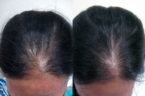 Hair loss treatment before and after 8