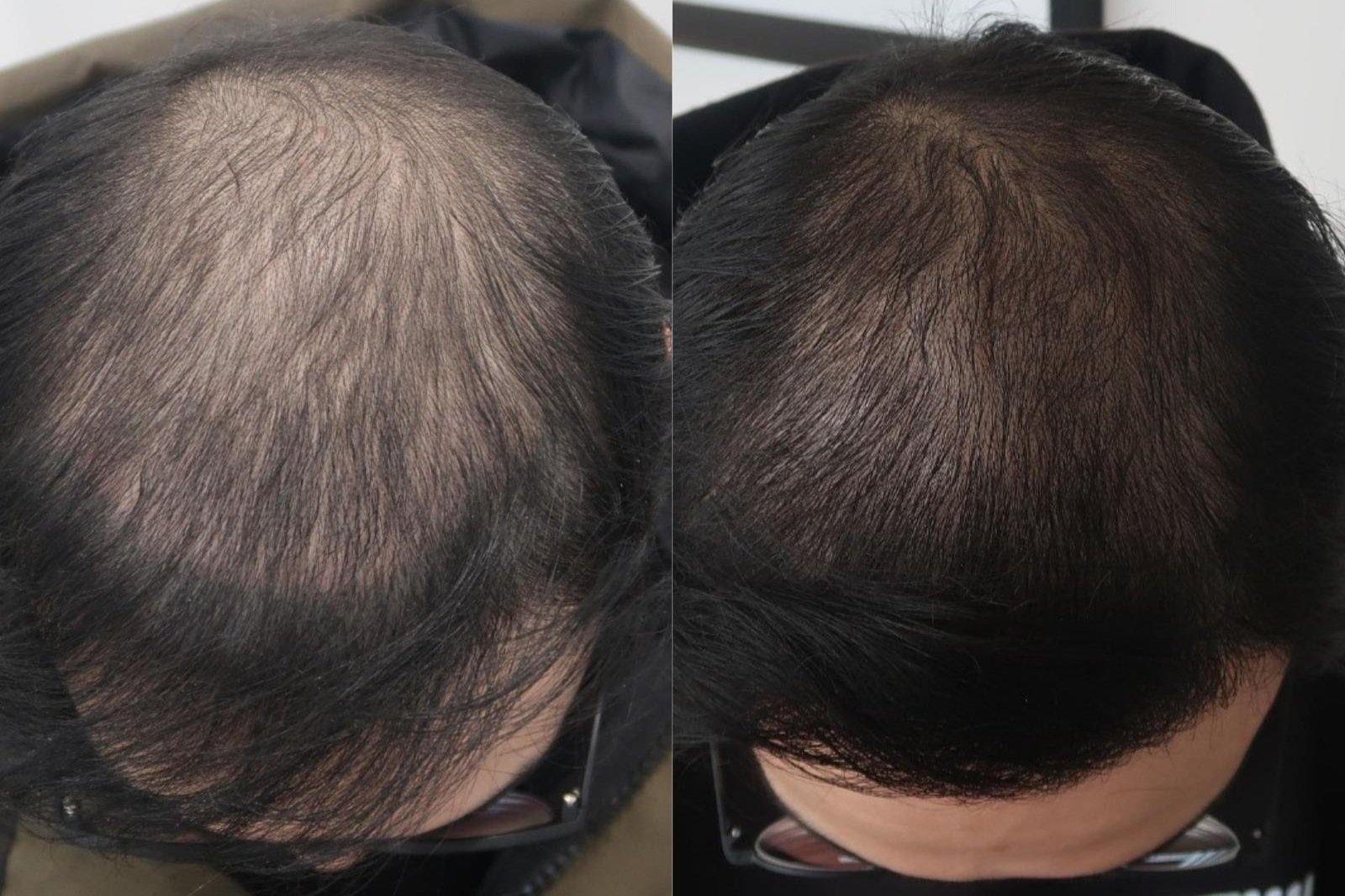 Hair loss treatment before and after 6