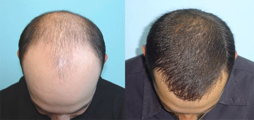 PRP hair loss treatment before and after 1