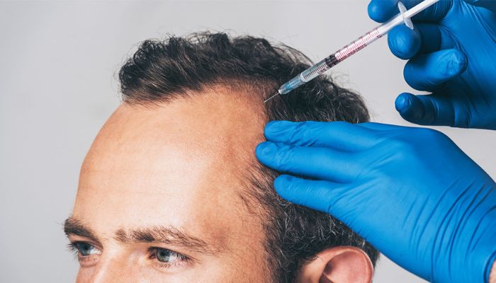 PRP Treatment for Hair Loss