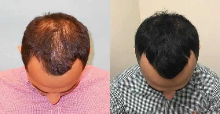 Hair loss treatment before and after 5
