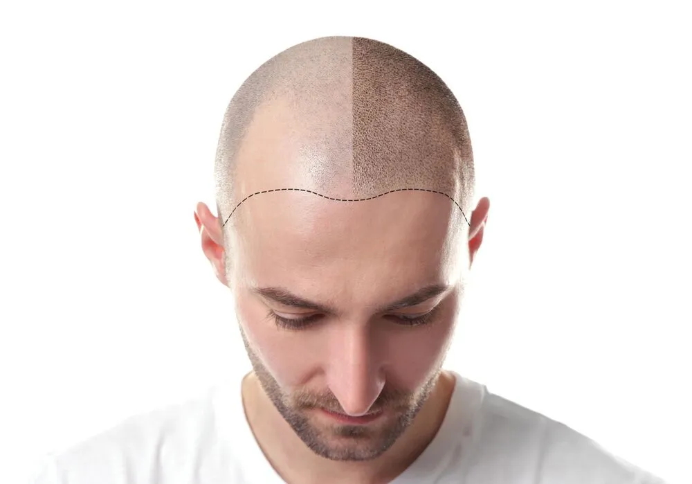 Scalp Micropigmentation SMP
